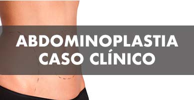 Abdominoplastia Caso Clínico - John Garcia Cirugía Plástica