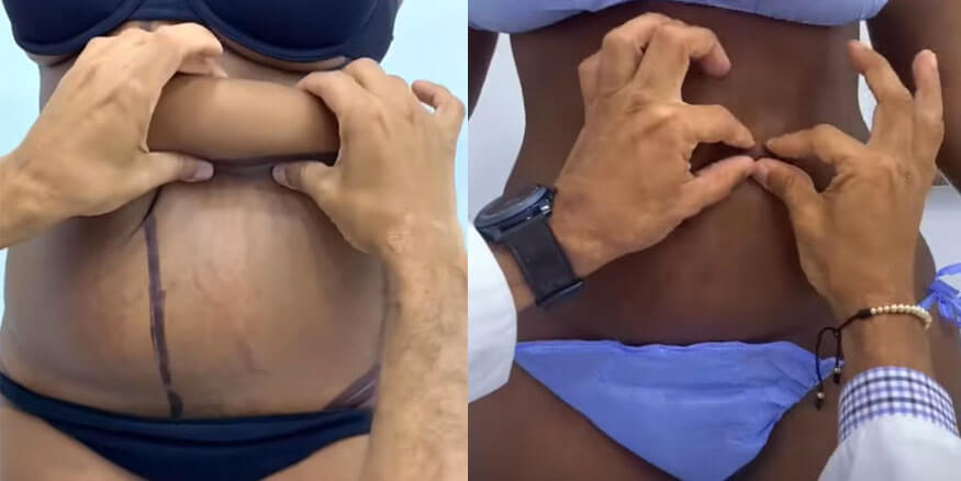 Resultados Antes y Después - Abdominoplastia Sin Cicatriz